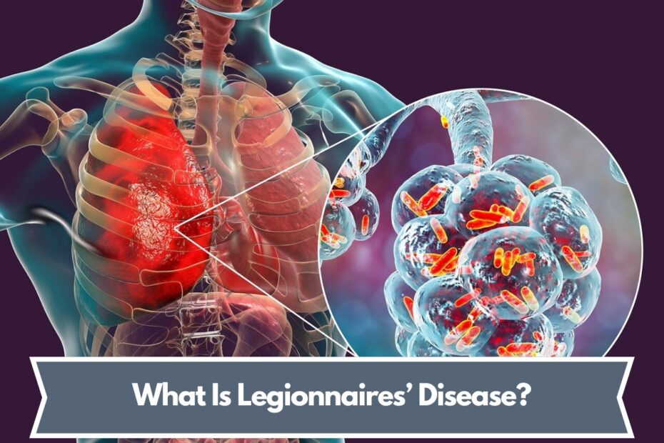 What Is Legionnaires’ Disease?